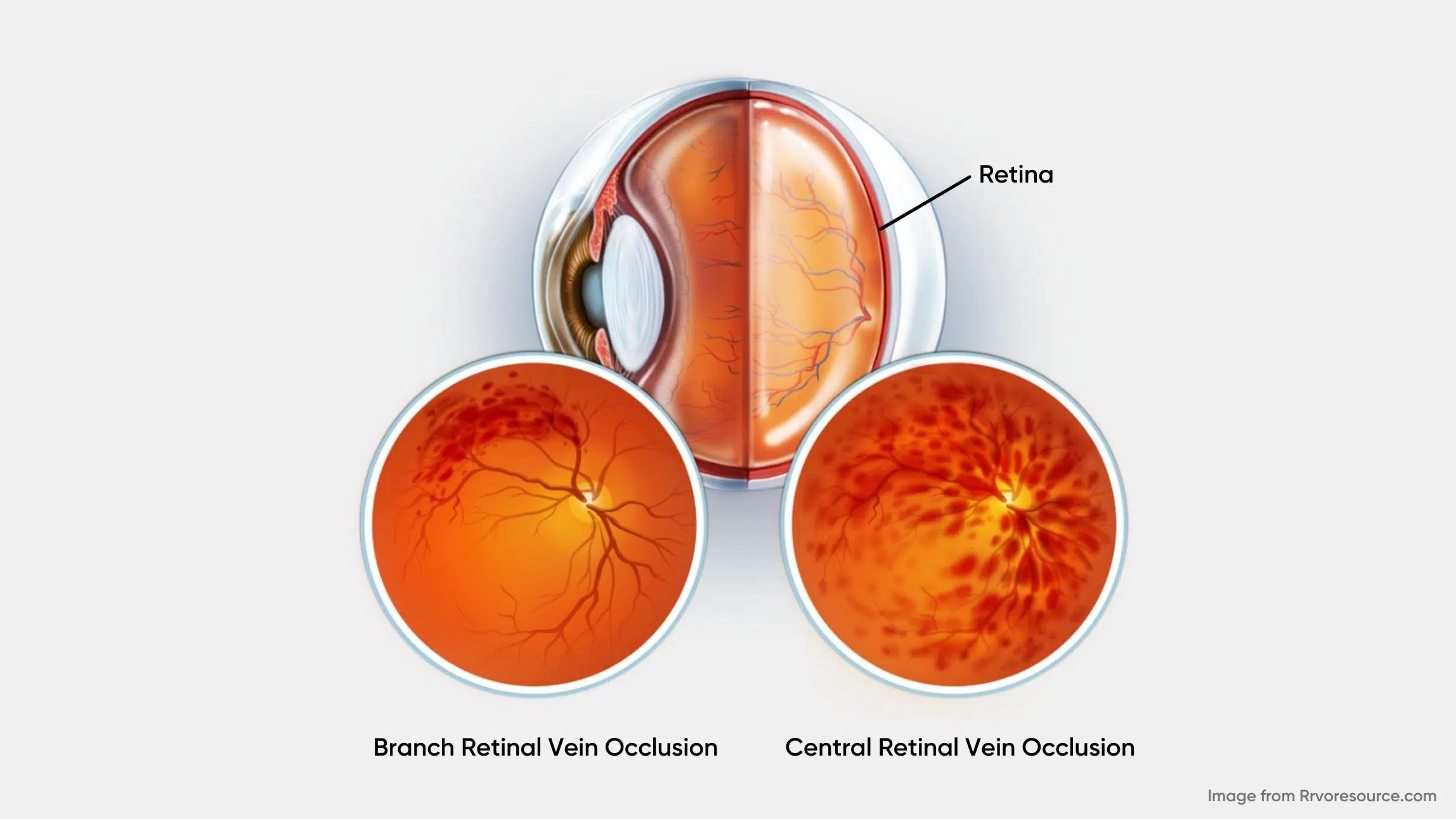 Branch Retinal Vein Occlusion (4)